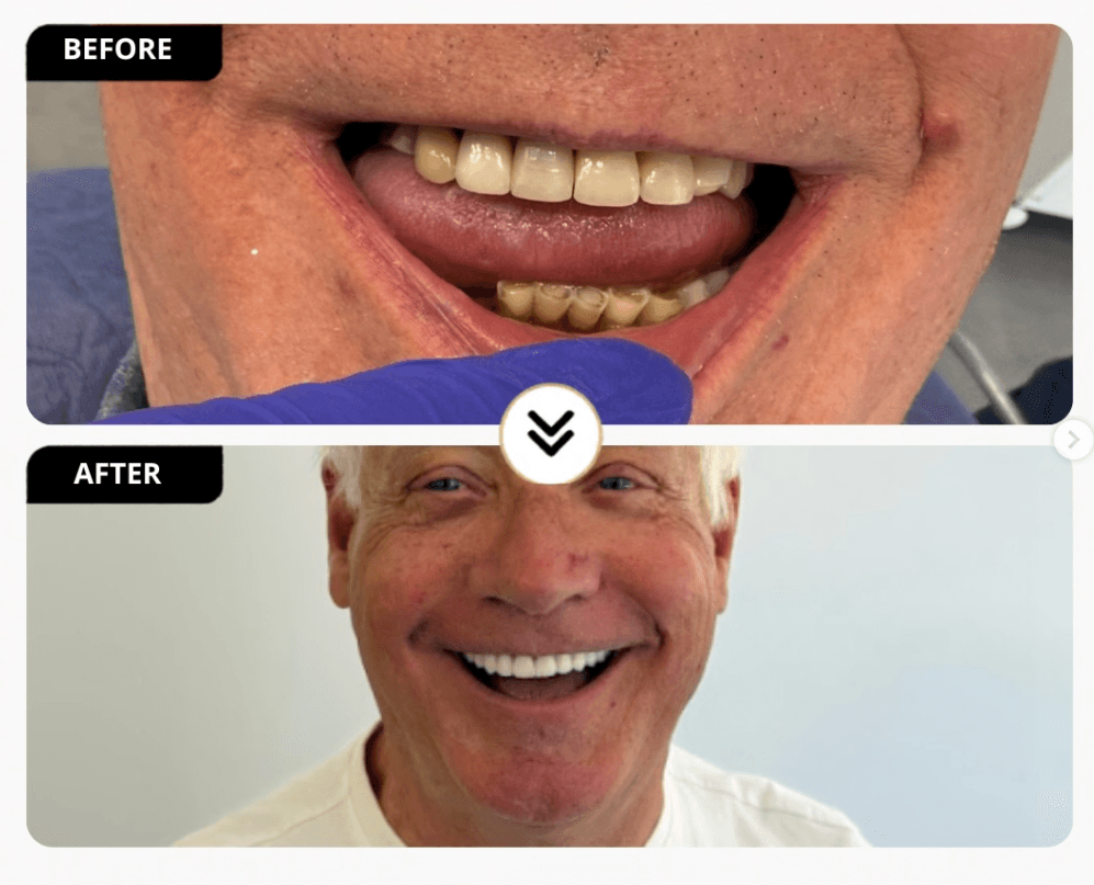Patient smile result 1 — Durres Dental Clinic