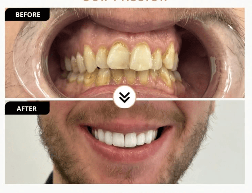 Patient smile result 3 — Durres Dental Clinic