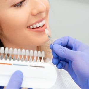 Faccette Dentali